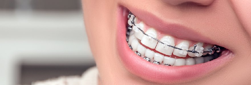 Установка брекетов Установка брекетов