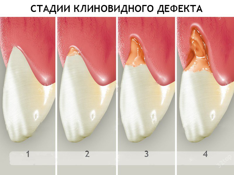 Лечение клиновидного дефекта зубов Лечение клиновидного дефекта зубов