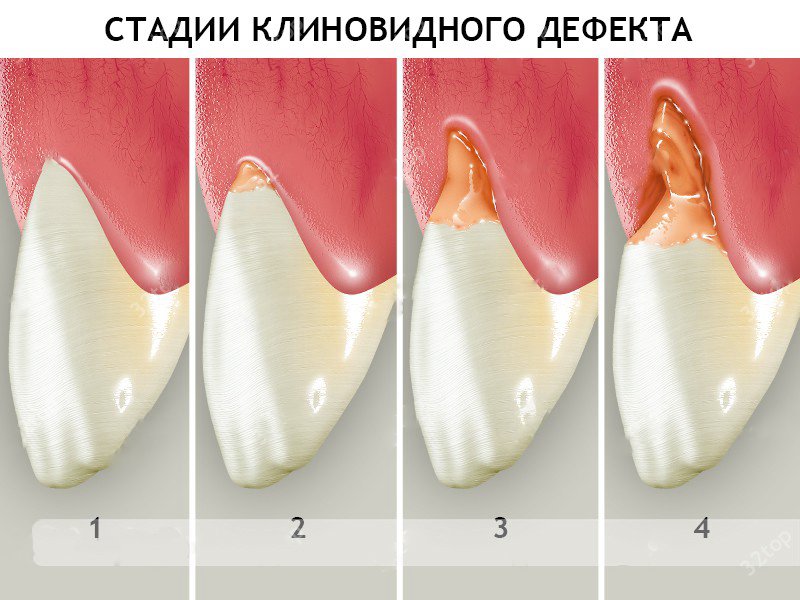 Лечение клиновидного дефекта зубов