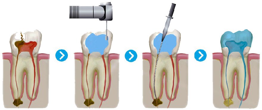 Лечение каналов зуба