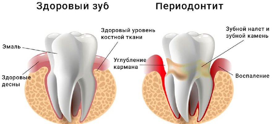 Лечение периодонтита