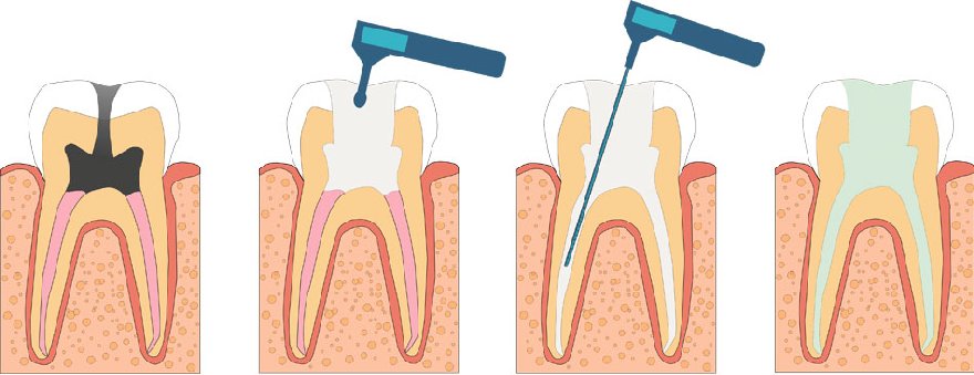 Лечение пульпита